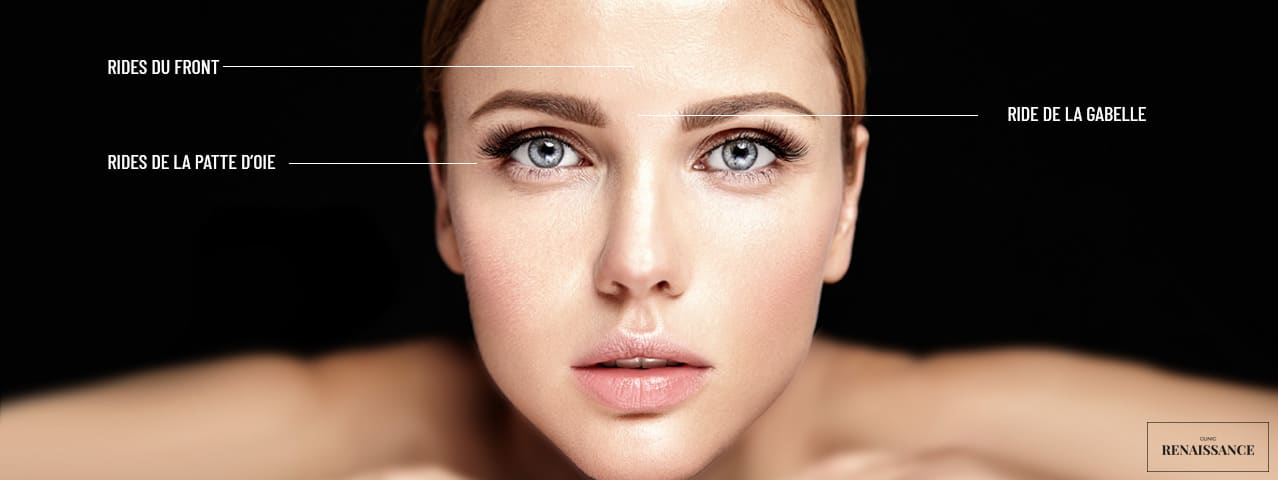 injection toxine botulique botox Lille Clinic Renaissance