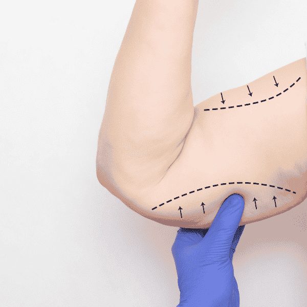 Dermolipectomie des bras pour retirer la peau tombante