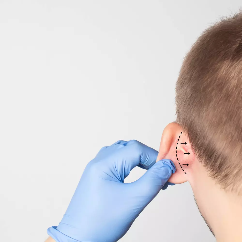 Corriger une oreille décollée avec l'otoplastie