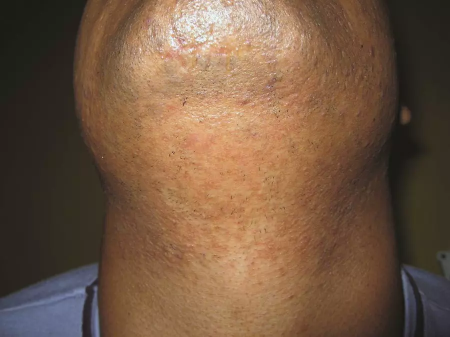 Photo d'un visage après de l'épilation laser définitive sur la barbe