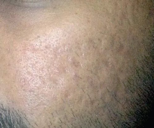 Après traitement par radiofréquence des cicatrices d'acné