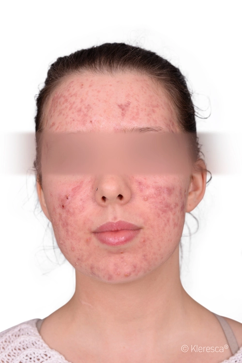 Photo avant traitement de l'acné avec Kleresca