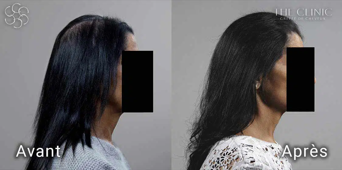 Avant / Après la pose d'implants Hairstetics sur une femme
