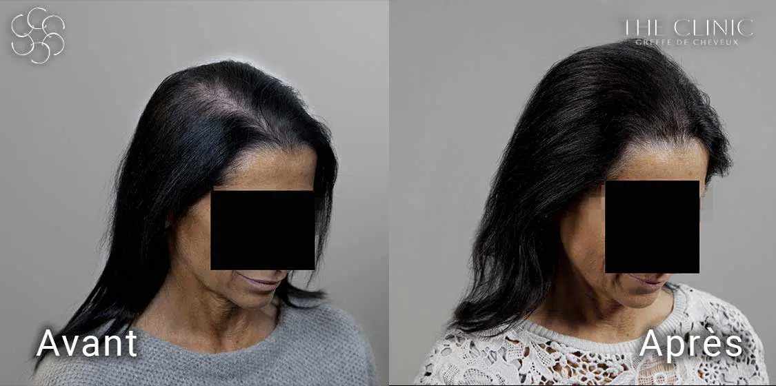 Avant / Après une intervention d'implantation capillaire Hairstetics