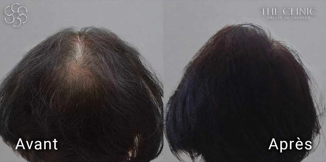 Avant / Après la pose d'implants capillaires synthétiques Hairstetics
