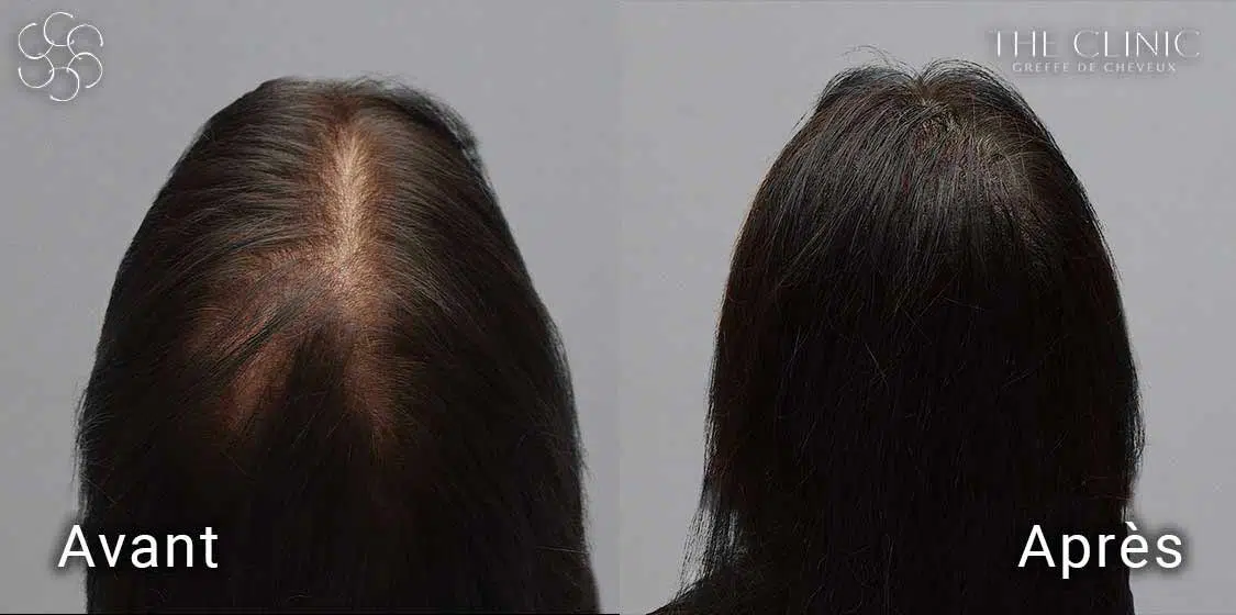 Avant / Après une implantation de cheveux Hairstetics