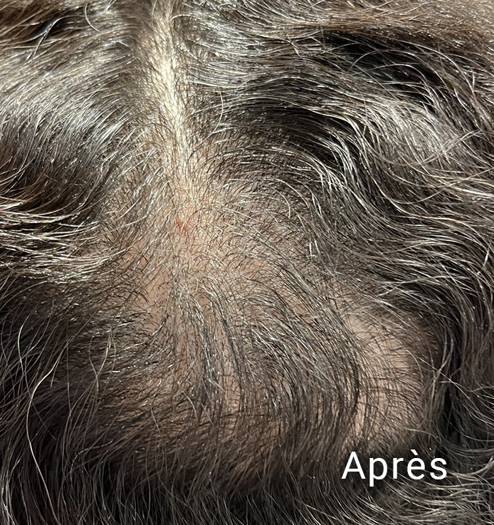 Alopécie corrigée chez un homme par le traitement PRP