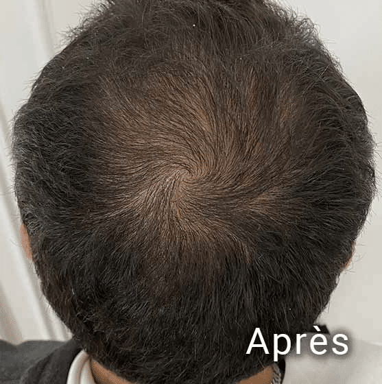 Greffe de cheveux après l'implantation