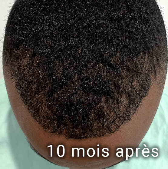 Microgreffe capillaire FUE 10 mois après l'implantation de cheveux