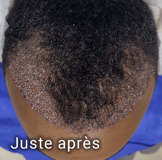 Microgreffe capillaire FUE juste après l'implantation de cheveux