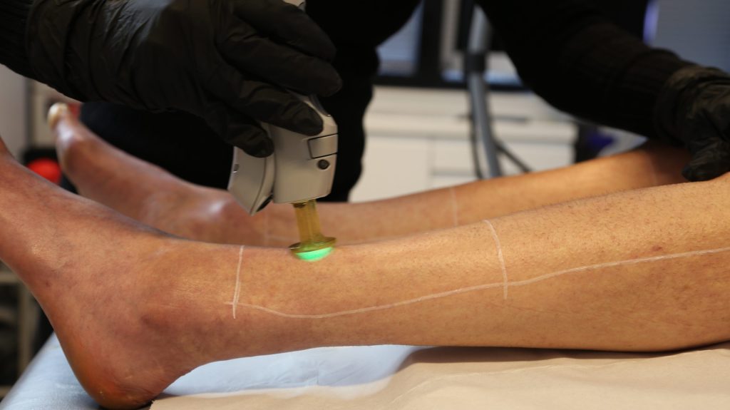 Epilation définitive au laser sur les jambes