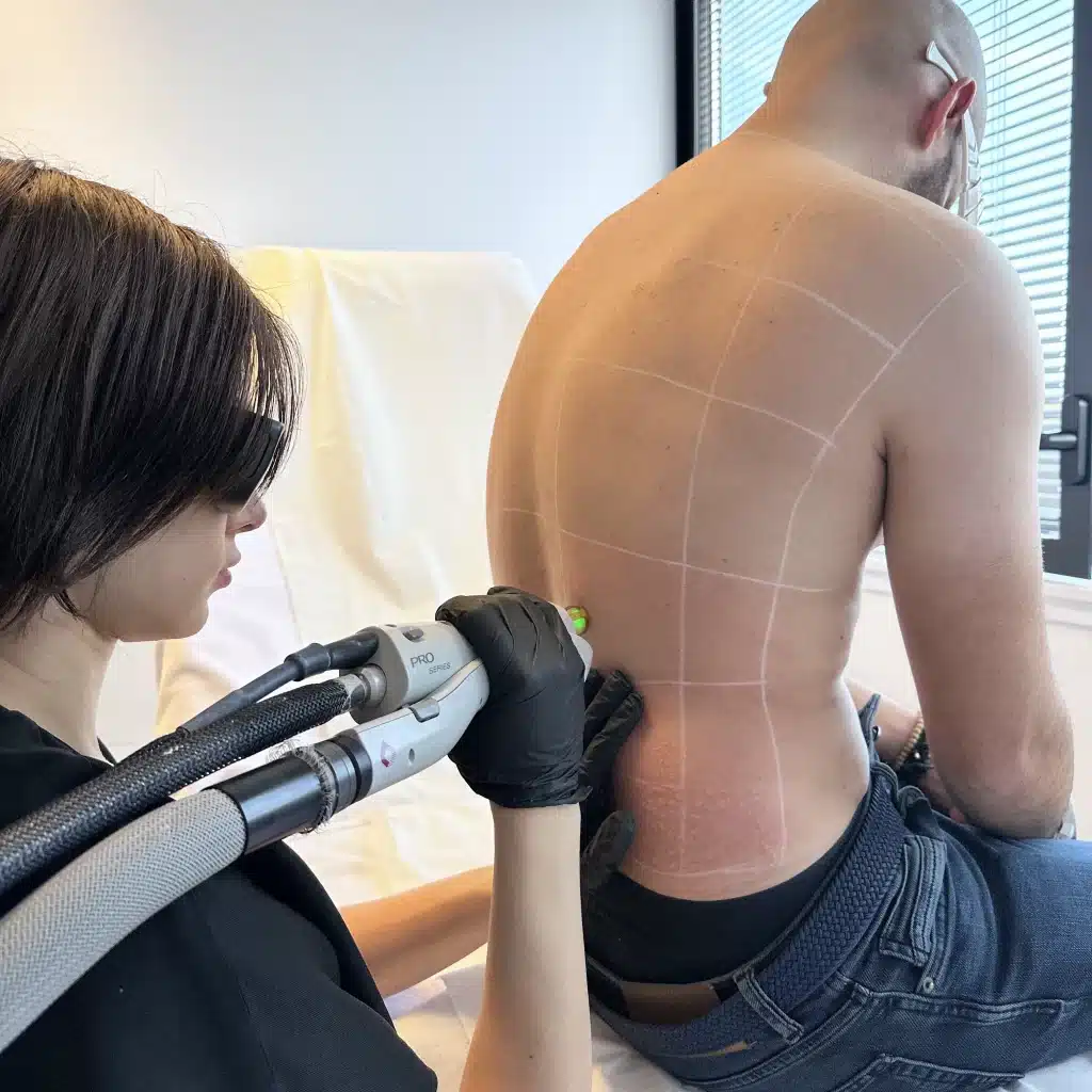 Découvrez l'avis de Romain sur l'épilation laser.