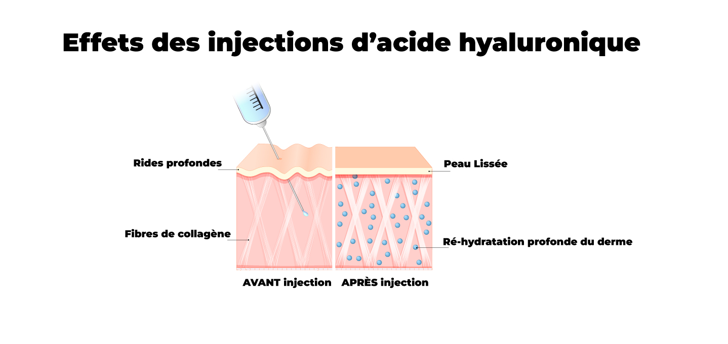effet injection acide hyaluronique
